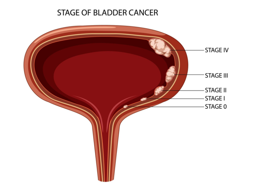 Bladder Cancer
